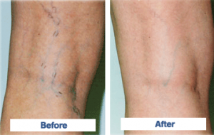 sclerotherapy_before_and_after